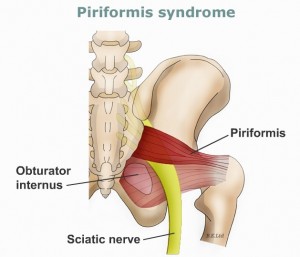 piriformis syndrome