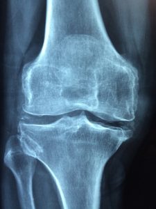 https://pixabay.com/en/knee-old-care-injury-pain-1406964/