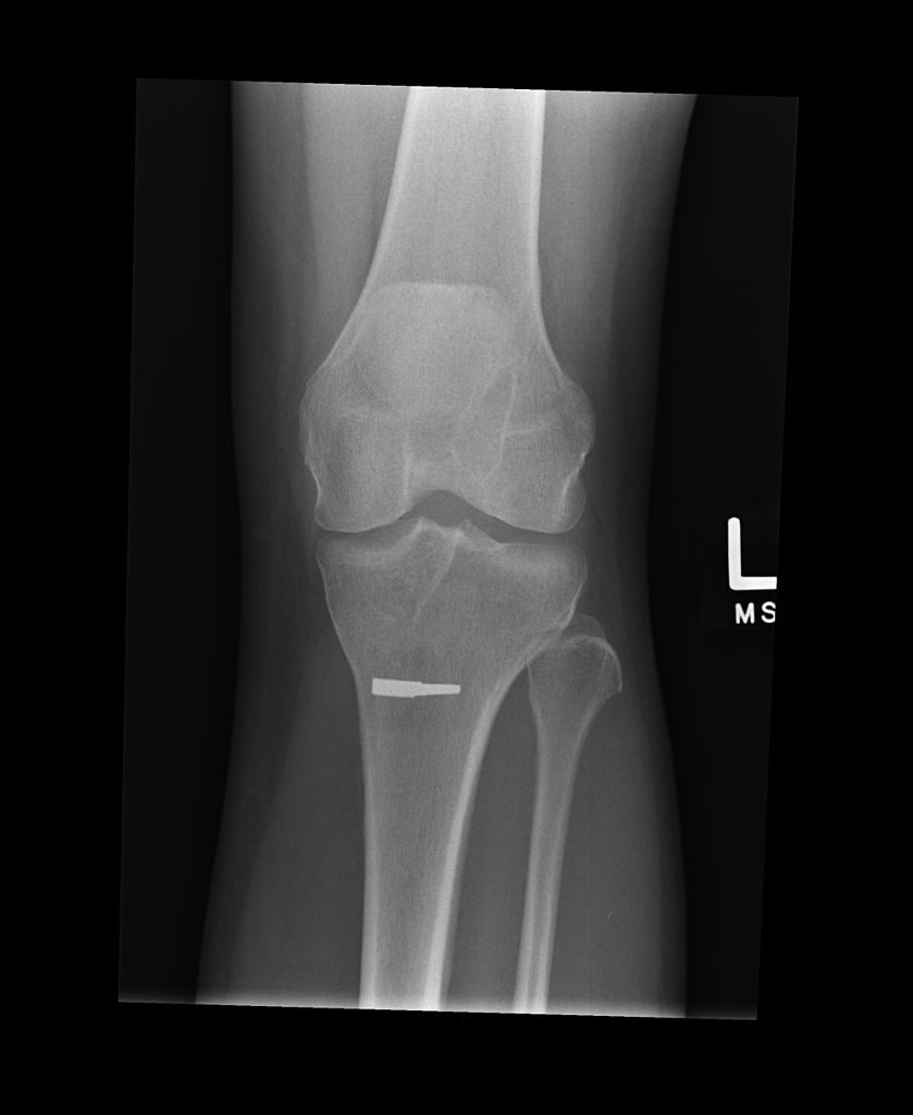 X RAY of a knee